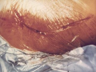 LESION (21)  IMAGENES FOTOS